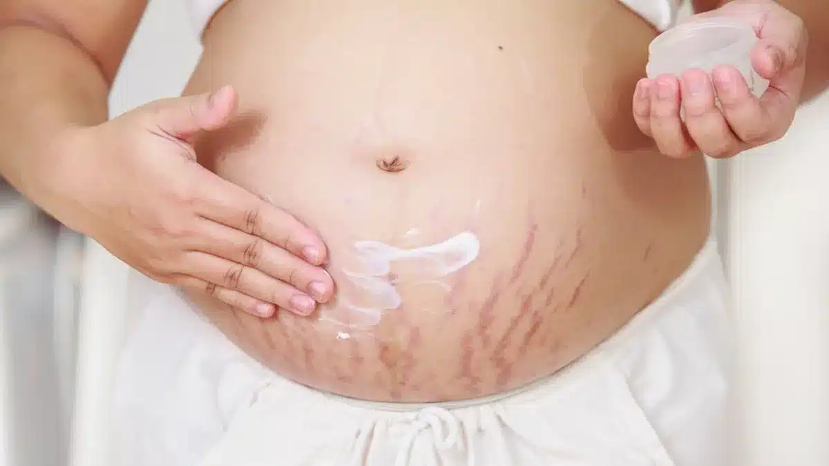 Stretch Marks Removal in Hindi