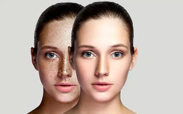 Read more about the article चेहरे के दाग धब्बे कैसे हटाए (घरेलू उपाय)