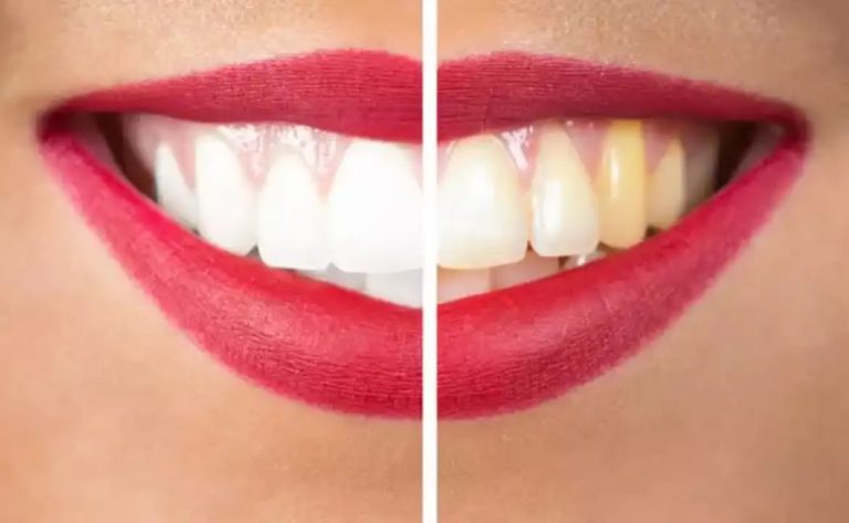 दांतों का पीलापन कैसे दूर करें | दांतों का पीलापन हटाने के उपाय